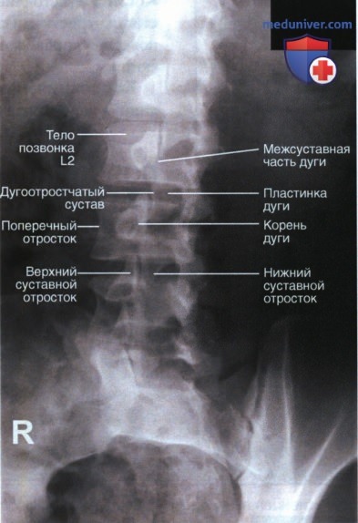 Рентгенограмма поясничных позвонков в косой ПЗ проекции