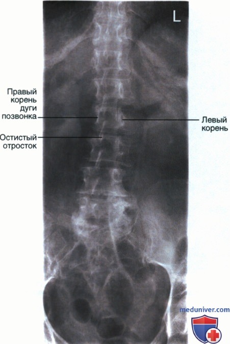 Рентгенограмма поясничных позвонков в ПЗ проекции