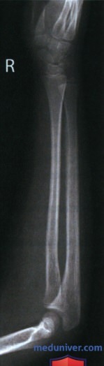 Укладка при рентгенограмме предплечья в боковой проекции (латеромедиальной)