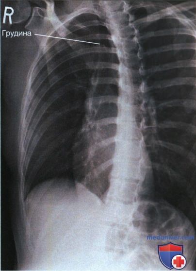 Рентгенограмма ребер в косой ПЗ проекции
