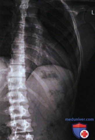 Рентгенограмма ребер в косой ПЗ проекции