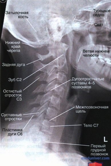 Укладка при рентгенограмме шейных позвонков в боковой проекции