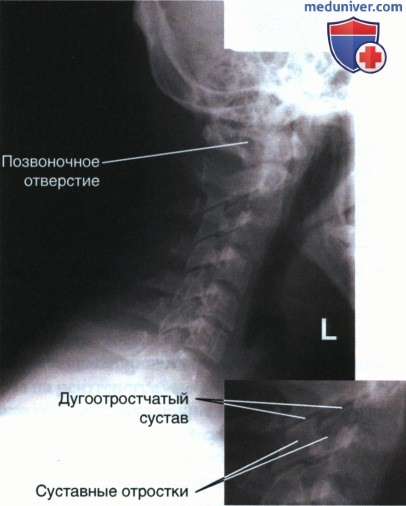 Рентгенограмма шейных позвонков в боковой проекции