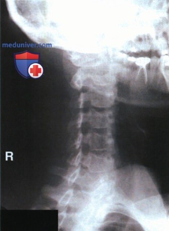 Укладка при рентгенограмме шейных позвонков в передней и задней косоаксиальной проекции
