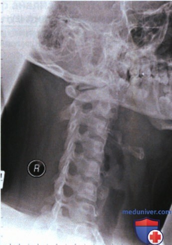 Укладка при рентгенограмме шейных позвонков в передней и задней косоаксиальной проекции