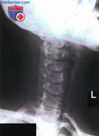 Рентгенограмма шейных позвонков в передней и задней косоаксиальной проекции