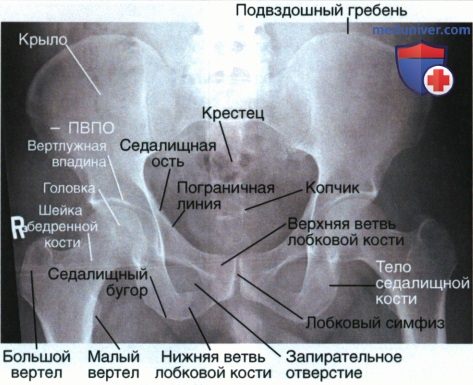 Рентгенограмма таза в передне-задней проекции (ПЗ проекции)