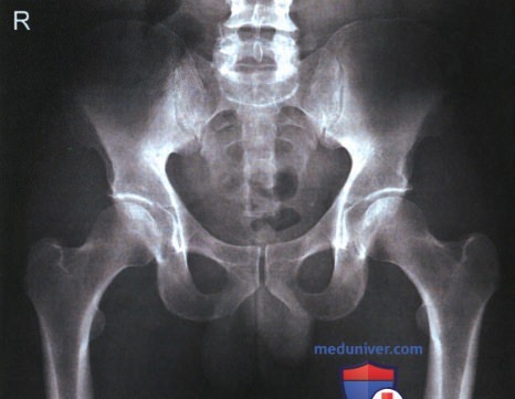 Рентгенограмма таза в передне-задней проекции (ПЗ проекции)