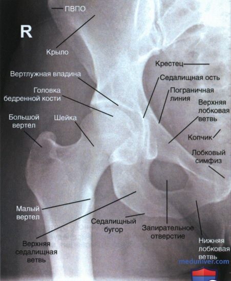 Рентгенограмма тазобедренного сустава в передне-задней проекции (ПЗ проекции)