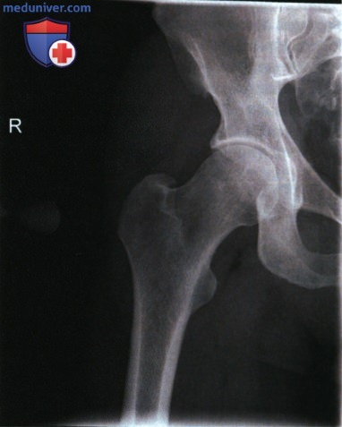 Рентгенограмма тазобедренного сустава в передне-задней проекции (ПЗ проекции)