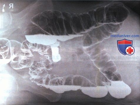 Рентгенограмма толстой кишки в ПЗ или ЗП проекции лежа на боку