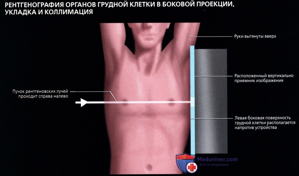 Рентген органов грудной клетки в боковой проекции: укладка, коллимация