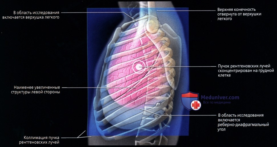 Рентген органов грудной клетки в боковой проекции: укладка, коллимация