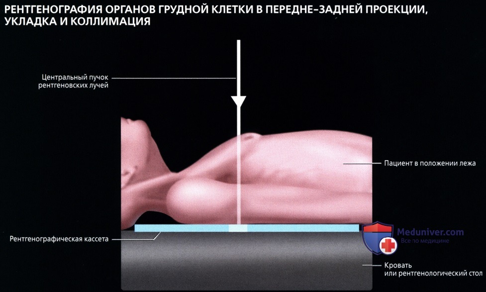 Рентген органов грудной клетки в передне-задней проекции: укладка, коллимация