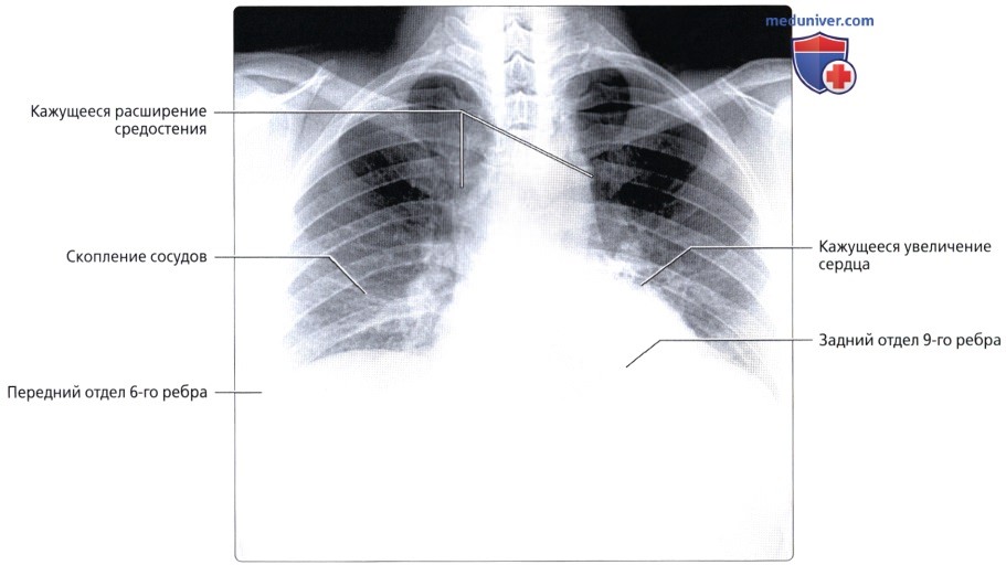 Рентген органов грудной клетки в передне-задней проекции: укладка, коллимация