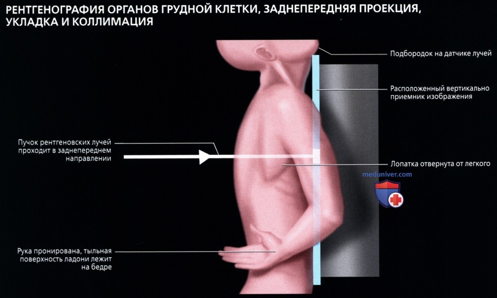 Рентген органов грудной клетки в заднепередней проекции: укладка, коллимация