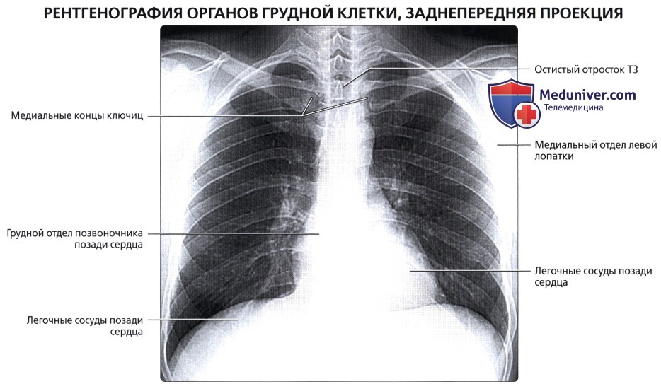 Рентген органов грудной клетки в заднепередней проекции: укладка, коллимация