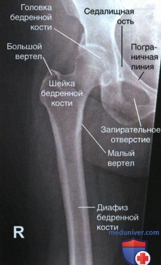 Рентгенограмма проксимального отдела бедренной кости в ПЗ проекции