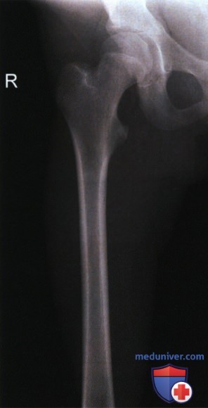 Рентгенограмма проксимального отдела бедренной кости в ПЗ проекции