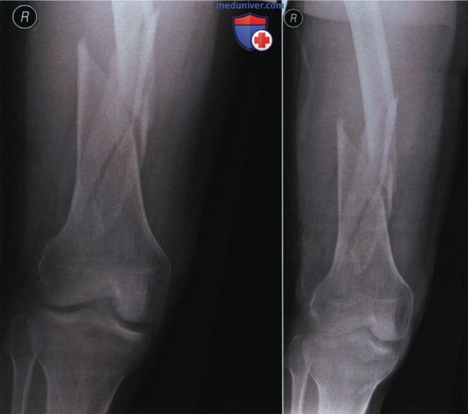 Укладка при рентгенограмме бедренной кости в ПЗ проекции