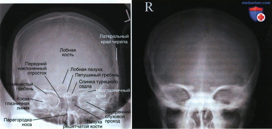 Укладка при рентгенограмме черепа и нижней челюсти в ЗП или ПЗ проекции