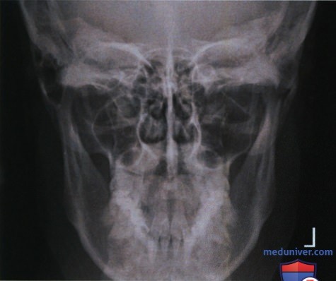 Рентгенограмма черепа и нижней челюсти в ЗП или ПЗ проекции