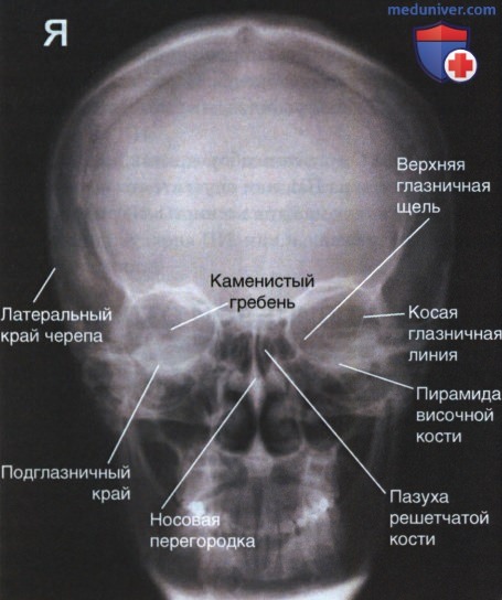 Укладка при рентгенограмме лицевого отдела черепа и придаточных пазух носа в аксиальной ЗП или ПЗ проекции по методу Колдуэлла
