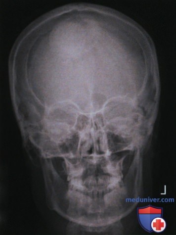 Рентгенограмма лицевого отдела черепа и придаточных пазух носа в аксиальной ЗП или ПЗ проекции по методу Колдуэлла