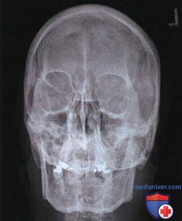 Рентгенограмма лицевого отдела черепа и придаточных пазух носа в аксиальной ЗП или ПЗ проекции по методу Колдуэлла