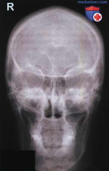 Укладка при рентгенограмме лицевого отдела черепа и придаточных пазух носа в аксиальной ЗП или ПЗ проекции по методу Колдуэлла