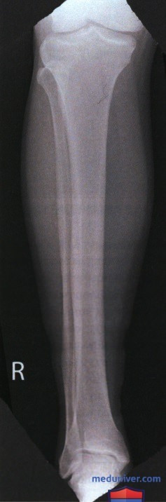 Укладка при рентгенограмме голени в ПЗ проекции
