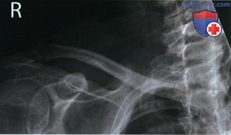 Укладка при рентгенограмме ключицы в передне-задней проекции (ПЗ проекции)