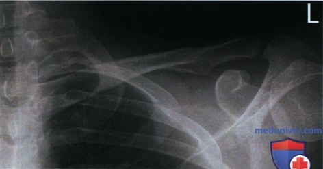 Укладка при рентгенограмме ключицы в передне-задней проекции (ПЗ проекции)