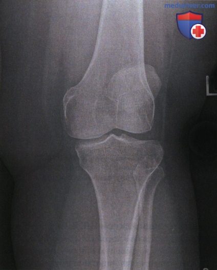 Укладка при рентгенограмме коленного сустава в косой ПЗ проекции (медиальной и латеральной ротации)