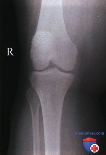 Укладка при рентгенограмме коленного сустава в косой ПЗ проекции (медиальной и латеральной ротации)