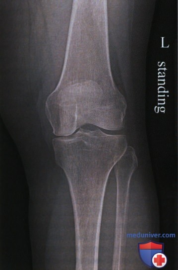 Укладка при рентгенограмме коленного сустава в ПЗ проекции