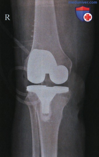 Укладка при рентгенограмме коленного сустава в ПЗ проекции