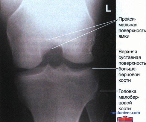 Укладка при рентгенограмме межмыщелковой ямки коленного сустава в аксиальной ПЗ проекции (по методу Беклера)