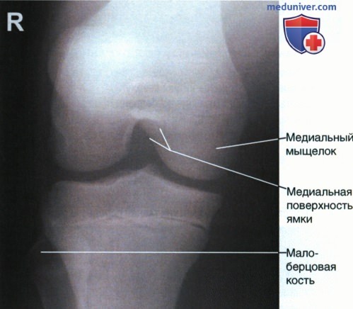 Укладка при рентгенограмме межмыщелковой ямки коленного сустава в аксиальной ПЗ проекции (по методу Беклера)