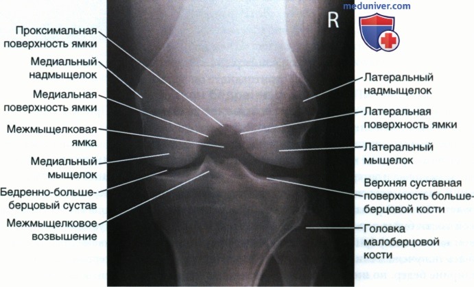 Укладка при рентгенограмме межмыщелковой ямки коленного сустава в аксиальной ЗП проекции (с нагрузкой и по методу Холмблада)