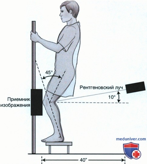 Укладка при рентгенограмме межмыщелковой ямки коленного сустава в аксиальной ЗП проекции (с нагрузкой и по методу Холмблада)