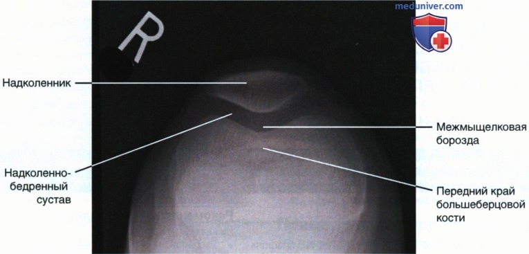 Рентгенограмма надколенника, надколенно-бедренного сустава в тангенциальной нижневерхней проекции и по методу Сеттегаста