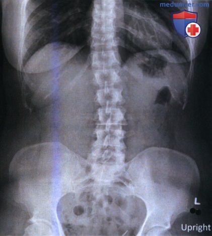 Рекомендации по анализу рентгенограмм органов брюшной полости (ОБП) ПЗ проекции (лежа на спине и стоя)