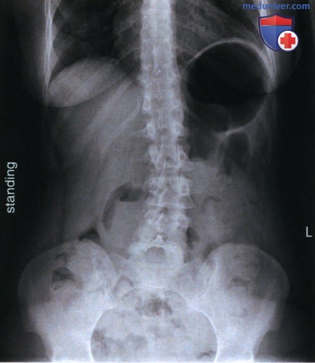 Укладка при рентгенограмме органов брюшной полости (ОБП) лежа на спине в ПЗ проекции