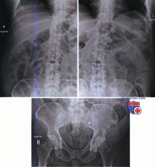Укладка при рентгенограмме органов брюшной полости (ОБП) стоя в ПЗ проекции (вертикальном положении)