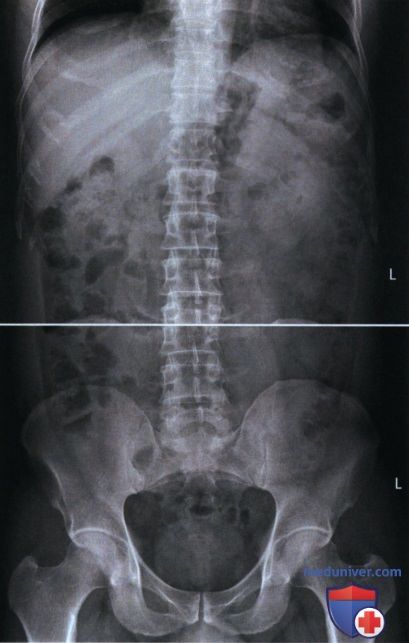 Укладка при рентгенограмме органов брюшной полости (ОБП) лежа на спине в ПЗ проекции