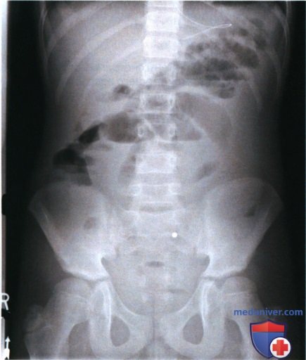 Рекомендации по анализу рентгенограмм органов брюшной полости (ОБП) у детей старшего возраста стоя и лежа на спине в ПЗ проекции