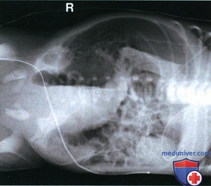 Рекомендации по анализу рентгенограмм органов брюшной полости (ОБП) у новорожденных и грудных детей лежа на боку в ПЗ проекции