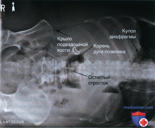 Рекомендации по анализу рентгенограммы органов брюшной полости (ОБП) лежа на боку в ПЗ проекции