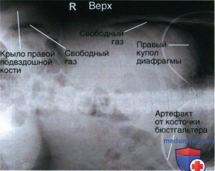 Укладка при рентгенограмме органов брюшной полости (ОБП) лежа на боку в ПЗ проекции